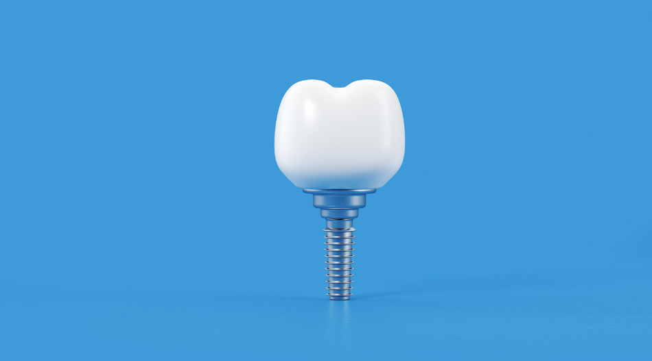 What is Tooth Implants