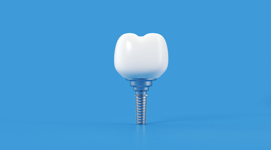 A Comprehensive Guide to Dental Implant Insurance - Dental Implants - 1