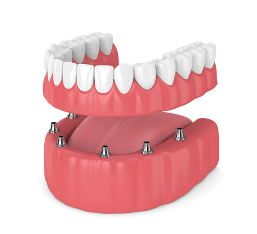 A Comprehensive Guide to Dental Implant Insurance - Dental Implants - 2 Full Mouth Dental Implants