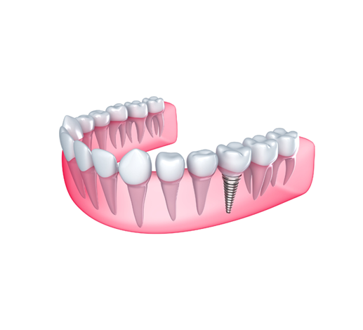 A Comprehensive Guide to Dental Implant Insurance - Dental Implants - 3