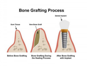 What to Expect from Bone Grafting for Dental Implants