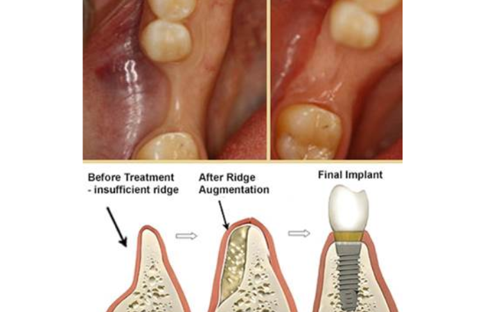 Bone Grafting Process For Dental