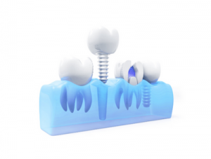 When Should You Get a Bone Graft with a Dental Implant