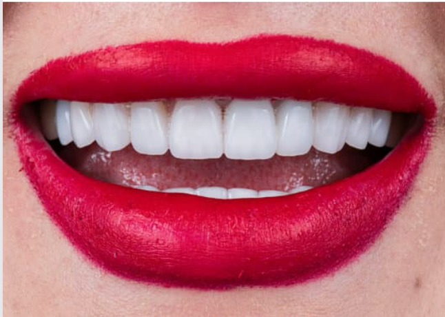 What To Expect When You Get a Full Mouth of Implants - Dental Implants - 1