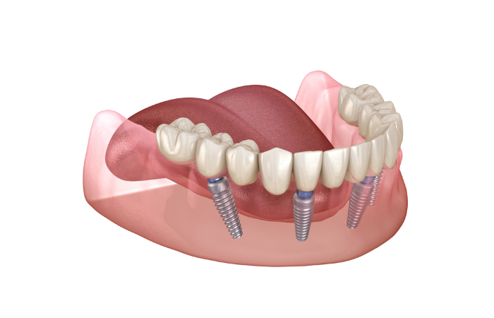 How Do Full Dental Implants Work