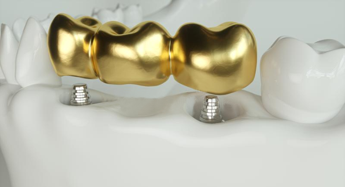 Gold Dental Implants