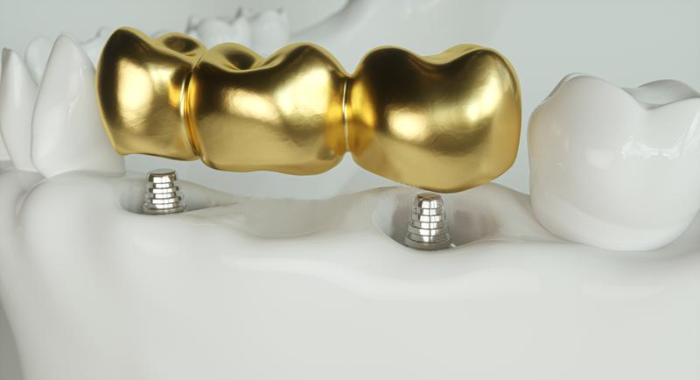 Gold Teeth Implants: What You Need To Know