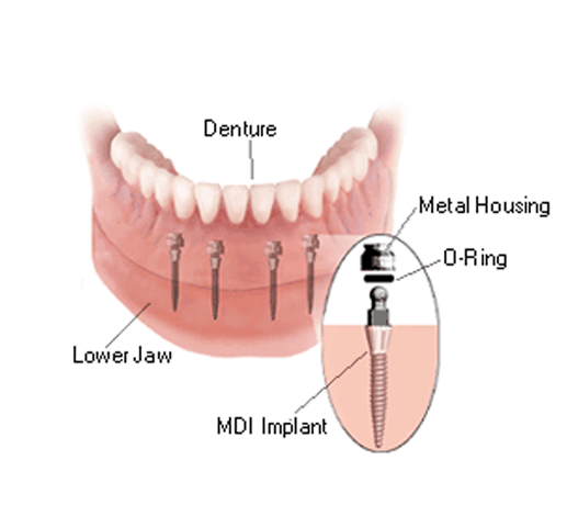 A Comprehensive Guide to Dental Implant Insurance - Dental Implants - 5
