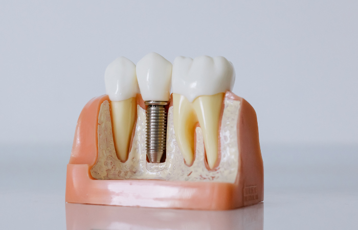 What Are Same-Day Dental Implants and Are They Right for You - Dental Implants - 1