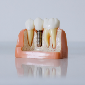 What Are Same-Day Dental Implants and Are They Right for You