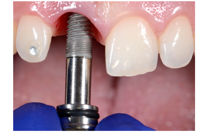 How to Get Dental Implants: A Detailed Guide - Dental Implants - 3