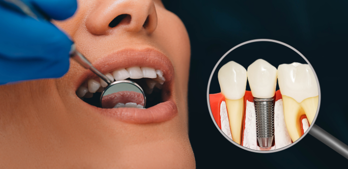 Is it too late for me to get dental implants - Dental Implants - 1