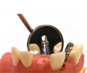 Dental Implant Adverse Effects Everyone Needs to Know