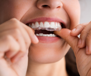 How Do Clear Aligners Work & Are They Right for You?