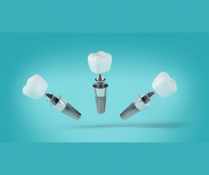 5 Best Dental Clinics in Europe For Dental Implants