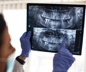 A Comprehensive Guide to Dental Implant Insurance - Dental Implants - 6