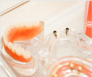 Should You Spend Money on Full-Arch Dental Implants or Dentures?