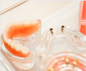 A Comprehensive Guide to Dental Implant Insurance - Dental Implants - 6