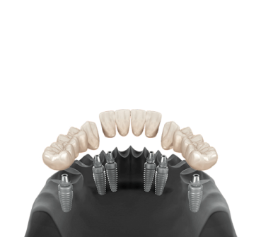 3 on 6 Tooth Implants