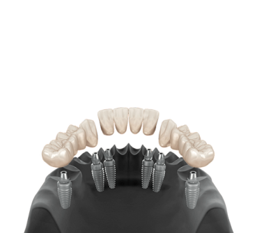3 on 6 Tooth Implants 3 on 6 Tooth Implants